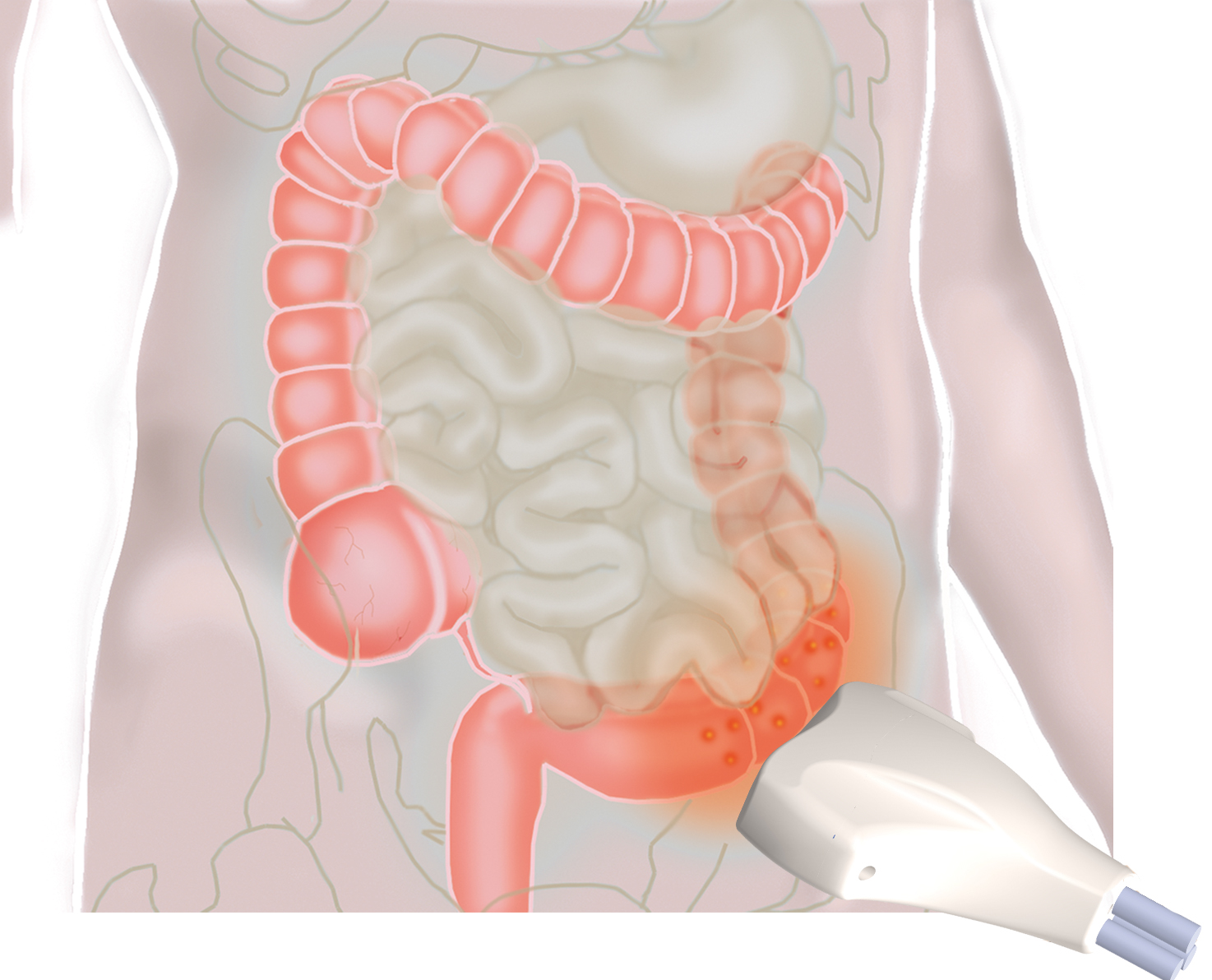 what-is-inflammatory-bowel-disease-live-science